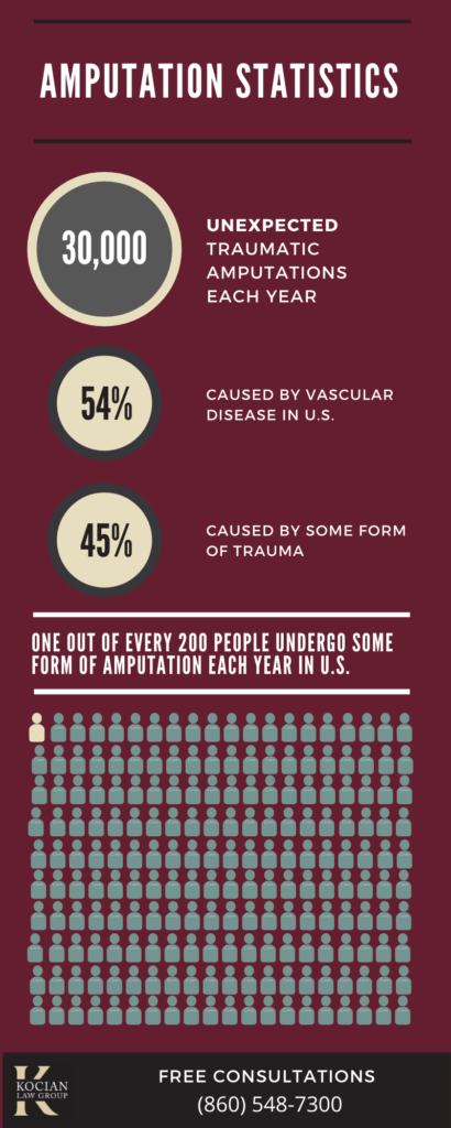 amputation stats infographic